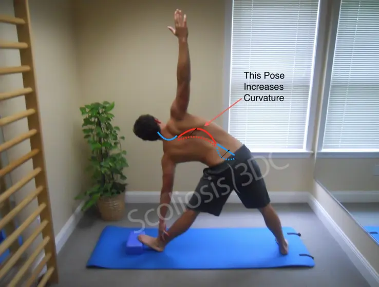 can yoga cure scoliosis - Can you fix scoliosis with exercise