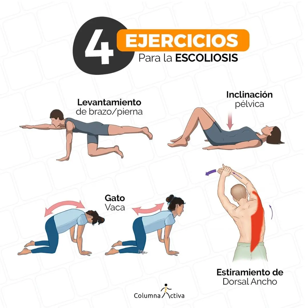 yoga terapeutico para escoliosis - Qué terapia es buena para la escoliosis